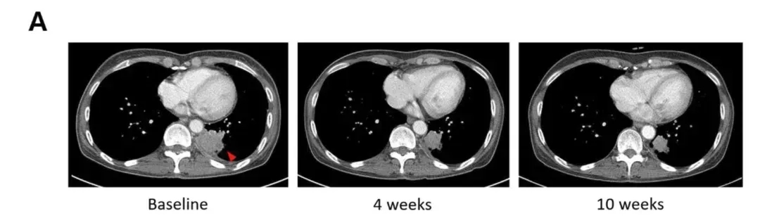 NK细胞疗法治疗肺癌的效果
