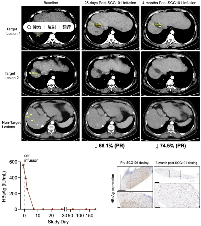 SCG101 TCR-T治疗肝癌的效果
