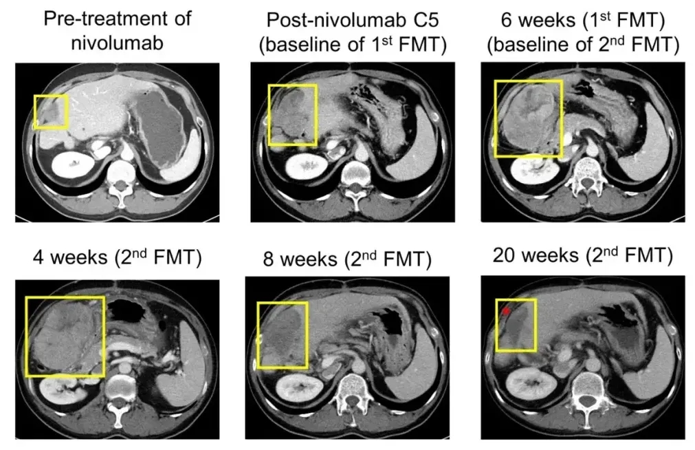 肠道菌群辅助治疗肝癌的效果