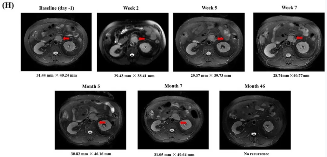 GPC3 CART细胞疗法治疗肝癌的效果
