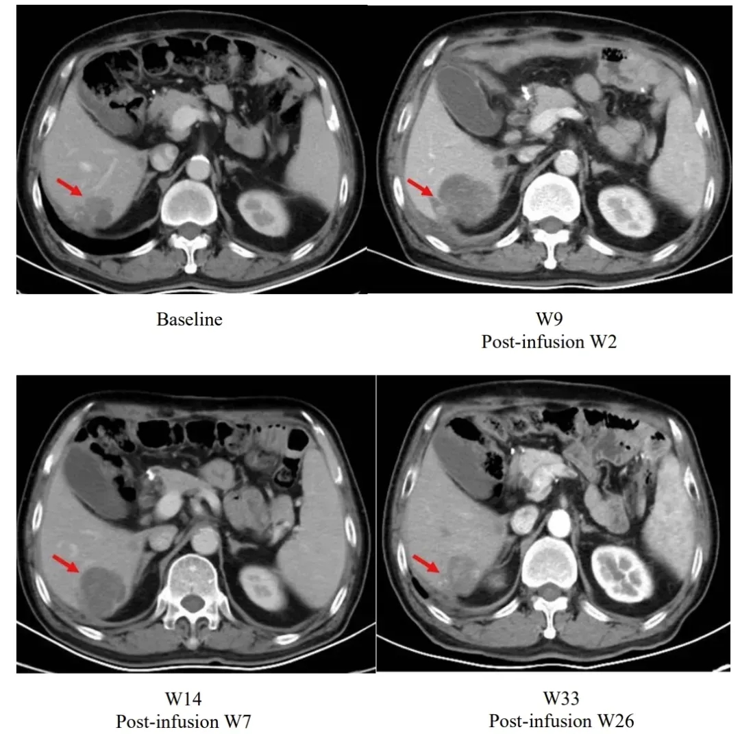 舒瑞基奥伦塞治疗胃癌的效果